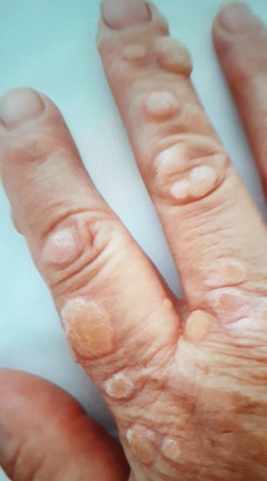 Close-up of human fingers with multiple raised common warts caused by HPV virus.