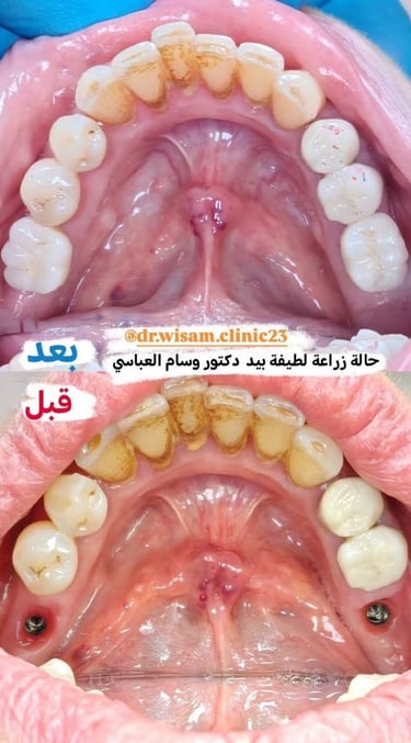 زراعة الأسنان - عيادة طب الاسنان دكتور وسام علي العباسي