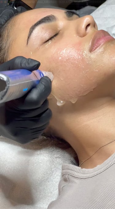 Microneedling showing a practitioner using a handheld device to enhance complexion