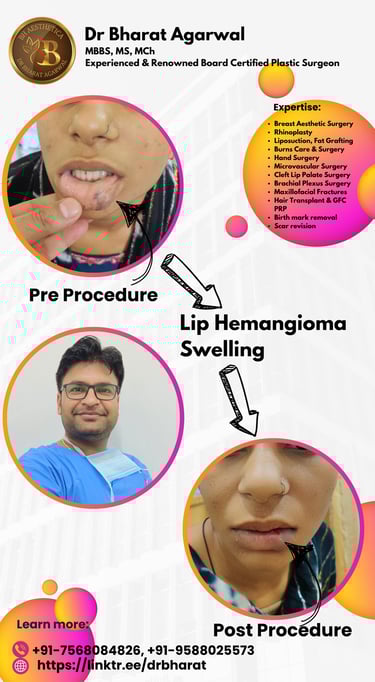 Lip Plastic Surgery in Udaipur.
