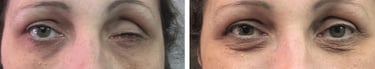 évisceration enucléation prothèse oculaire oculariste nice france avfrance awada