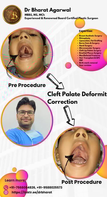 Cleft Lip Cleft Palate Plastic Surgery In Udaipur