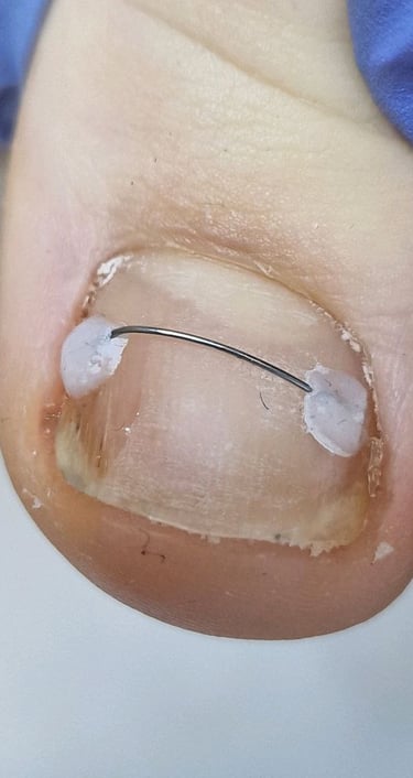 nago korekcija titano siulas