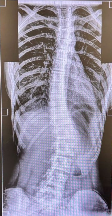 Dr Sivaraj Specialist Spine surgeon in Salem. Specialises in Scoliosis management