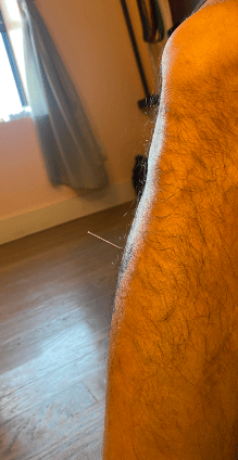 a pic showing an acupuncture needle in the shin muscle of the author, point name Stomach 36