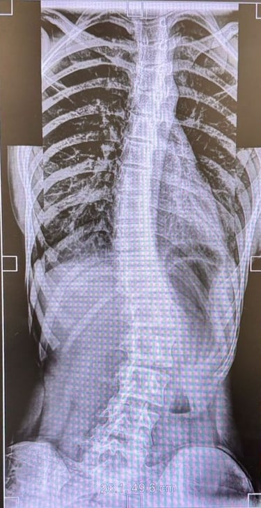 Dr Sivaraj Specialist Spine surgeon in Salem. Specialises in Scoliosis management