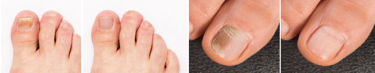 onicomicosis