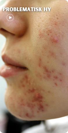a woman with acne