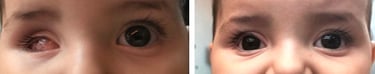rétinoblastome évisceration enucléation prothèse oculaire oculariste nice france avfrance awada