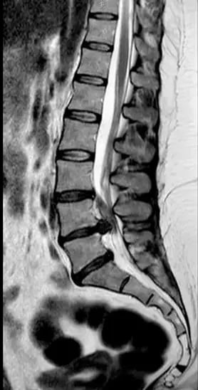 RMN de hernia lumbar