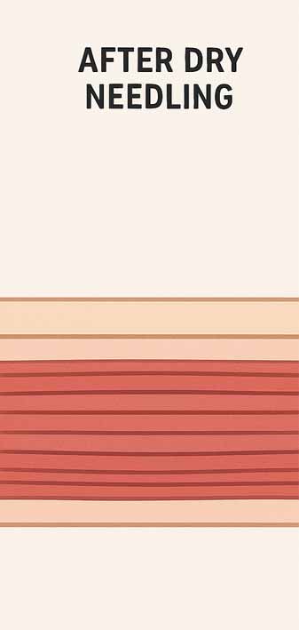 diagram showing how the muscle goes after the trigger point is released