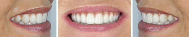 Fixed zirconia bridges for the All on 4 procedure