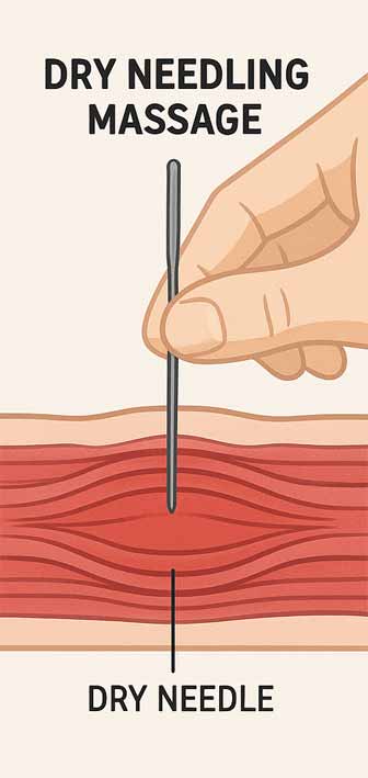 diagram showing a needle going into a trigger point knot