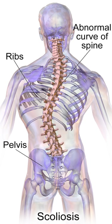 Scoliosis treatment in Muscat