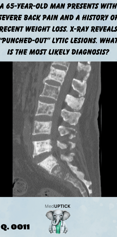 MRI imaging showing punch our lesions of the tailbone of the spine