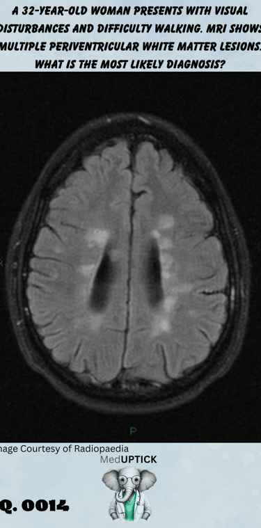 brain CT scan with multiple periventricular white matter lesion