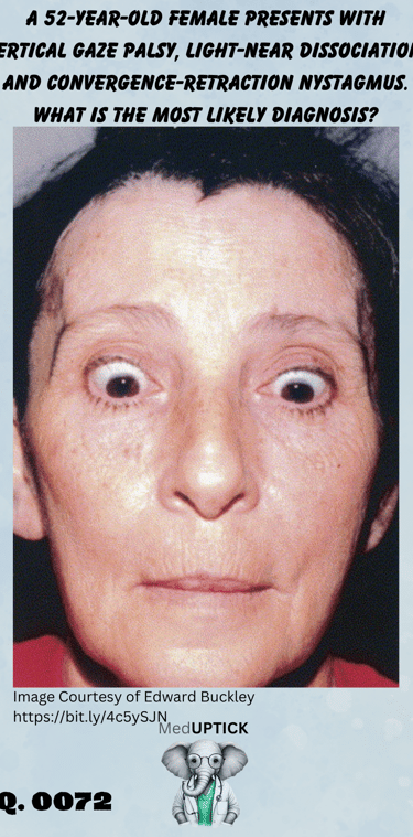 close up of a woman's face who has vertical eye palsy