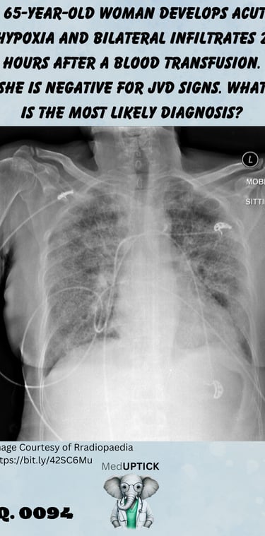 a chest x-ray of a woman with bilateral infiltrates