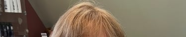 After permanent non-surgical hair replacement #18 with strand by strand method – softer, thicker app