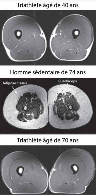 IRM muscle sarcopénie athlète sportif