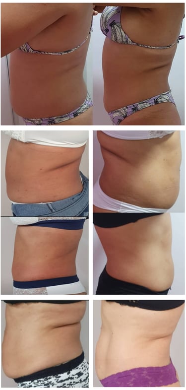 Lipo Enzimática em BH