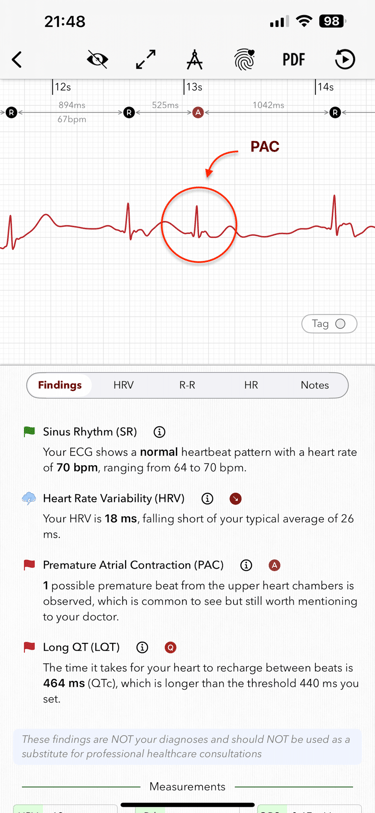 Screenshot of ECG+ app showing an Apple Watch ECG with a marked Premature Atrial Contraction (PAC)
