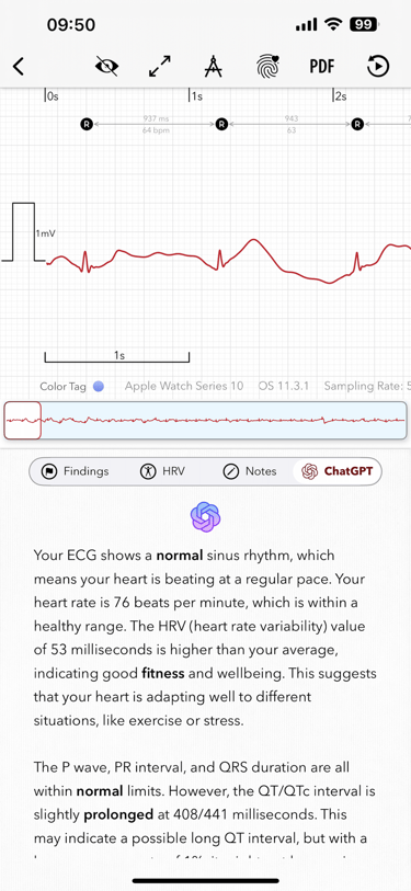 Screenshot of ECG+ app showing GPT-5 is explaining the findings on the Apple Watch ECG report