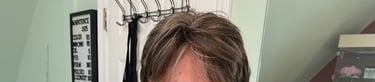 After permanent non-surgical hair replacement #17 with Micropoint Helix solution – fuller part and s