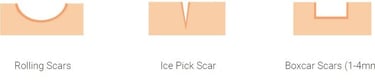 types of accne scars rolling ice pick boxcar scars
