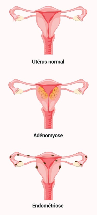 PESTICIDES SANTÉ FEMMES ADÉNOMYOSE ENDOMÉTRIOSE