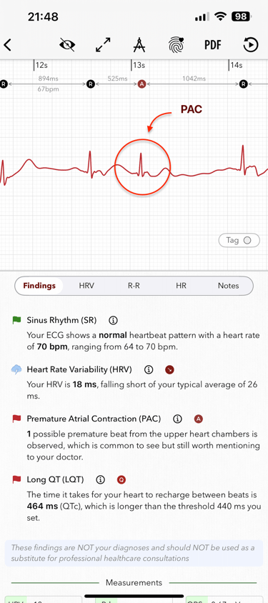 An screenshot of ECG+ app showing a premature atrial contraction (PAC) is detected on an ECG report