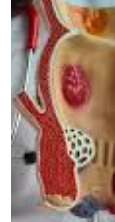 Analgesic properties: Honey relieves pain and itching associated with fissures and fistulas