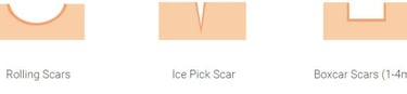 types of acne scars diagram aesthetic clinic acne treatment
