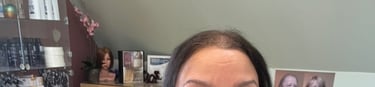 Before permanent non-surgical hair replacement #25 – diffuse thinning across the top with visible sc
