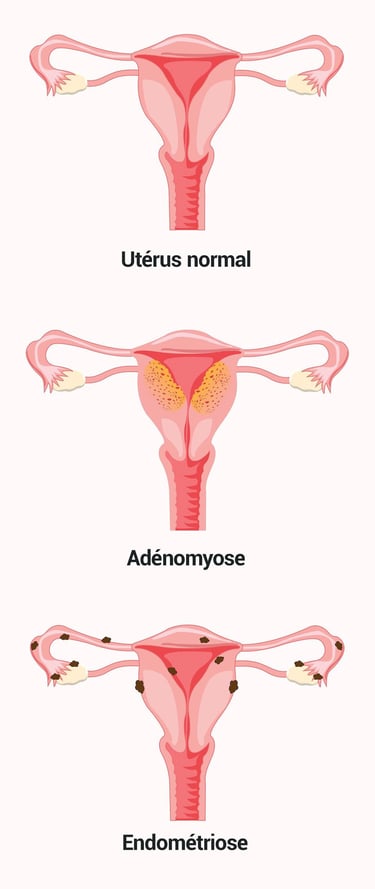 PESTICIDES SANTÉ FEMMES ADÉNOMYOSE ENDOMÉTRIOSE