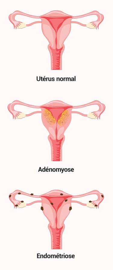 PESTICIDES SANTÉ ADÉNOMYOSE ENDOMÉTRIOSE