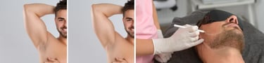 side by site pictutes laser bear definition and before and after men under arms laser