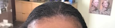 Before permanent non-surgical hair replacement #8 – widened part line showing scalp – woman in Danve