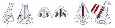 Various rhinoplasty graft graphics I created to support reels