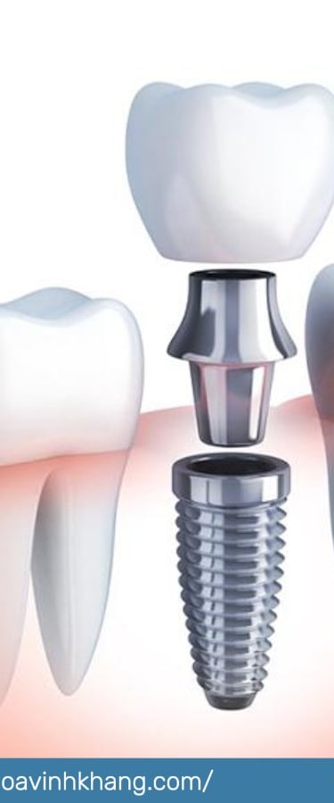 trồng răng Implant