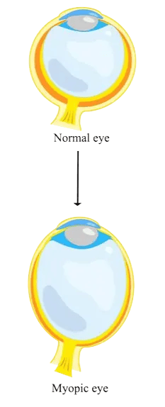normal eye vs myopia eye diagram showing how myopia eye disease is caused