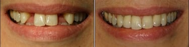 Dental implants Santiago Dominican Republic