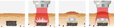 laser tattoo removal diagram singapore
