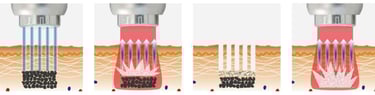 Fotona FracTAT laser tattoo removal singapore