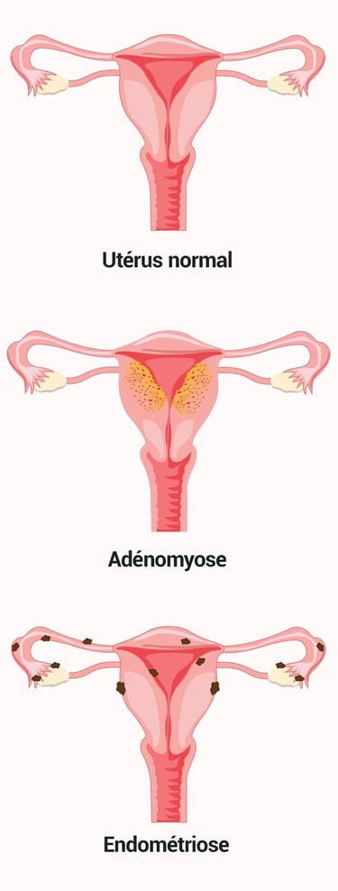 PESTICIDES SANTÉ ADÉNOMYOSE ENDOMÉTRIOSE