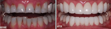 Cosmedic Express clinics in Turkey/Albania perform Dental Implants and Cosmetic Dentistry