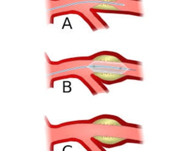 angioplasty