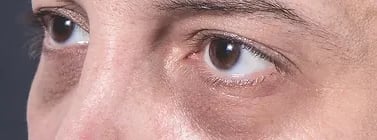 Dark Circles ray and rio's speciality clinic
