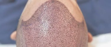 Hair Transplant  ray and rio's speciality clinic