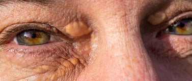 Xanthelasma Removal  ray and rio's speciality clinic